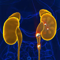  Remove stone from Kidney without surgery immediately.